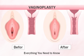 Vaginoplasty: Everything You Need to Know