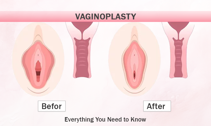 Vaginoplasty: Everything You Need to Know