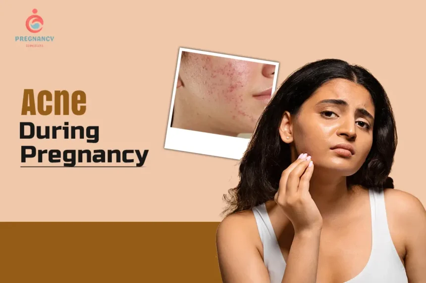 Acne During Pregnancy: Causes, Symptoms, Safe Treatments, and Skincare Tips for Moms-to-Be